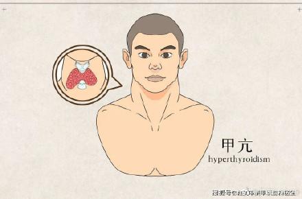 甲亢的饮食禁忌 ？得了甲亢，饮食、生活上有什么禁忌？